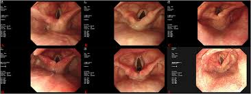 Image result for Acute Laryngitis