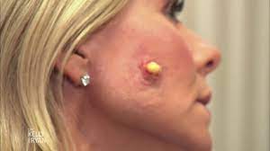 This is a place to share pimple & cyst popping videos. Live S Halloween Countdown Dr Pimple Popper Youtube