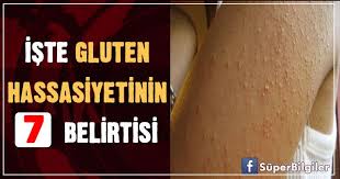Gluten Icermeyen Urunlerin Sayisinin Giderek Artmasiyla Gluten Hassasiyeti Rahatsizligi Herkes Tarafindan Bilinmeye Basladi Yine De Doktorlar Diyet Beslenme