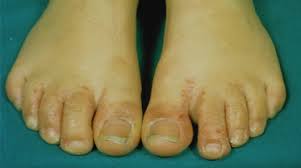 Image result for pompholyx soles of feet