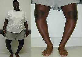 Randy The Bowlegged Cowboy Bow Legged Correction Bow Legged Genu Varum