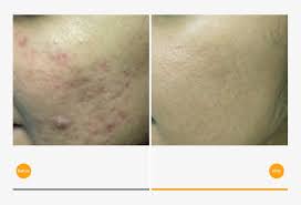 Acne affects about 85% of the population between ages 12 and 25 years old, and lots of people may also get acne scars after their acne goes away. Acne Scars Treatment Tixel Before And After Acne Scars Free Transparent Png Download Pngkey
