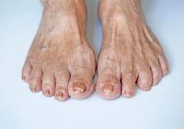 Image result for Koilonychia feet