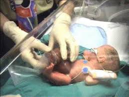 Surgical management for intestinal atresia. Experience Of Bedside Preformed Silo Staged Reduction And Closure For Gastroschisis Journal Of Pediatric Surgery