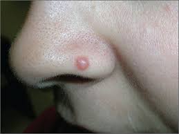 Image result for Spitz Nevus