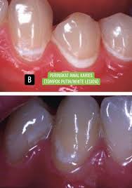 Maybe you would like to learn more about one of these? Kerosakan Gigi Susu Boleh Mengganggu Perkembangan Anak Dr Kongsi Tips