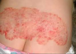 Herpes is one of the most common sexually transmitted diseases which can affect multiple organ systems including the lips and. Pin On Acne Treatment