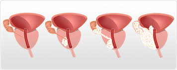  23, 40, 41 two types of rattle have been identified: Prostate Cancer Stages And Diagnosis Hifu Prostate