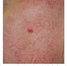 Merkel cell carcinoma (mcc) which is also known as neuroendocrine carcinoma or trabecular cancer is a rare cancer that occurs when the growth of. Figure 2 From Merkel Cell Carcinoma Semantic Scholar
