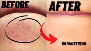 Check out the best advice and treatments for eliminating those big white zits. How To Remove Whiteheads And Blackheads From Chin At Home Youtube