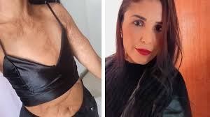 Moradora da Serra que teve 35% do corpo queimado luta e pede ajuda para  reconstruir mama