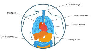 Epithelioid mesothelioma is the most common cell type of mesothelioma cancer. Mesothelioma What Are It S Causes Symptoms Prognosis Learn More