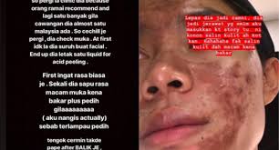 Menurut doktor perubatan estetik, kulit dan rawatan lazer dr nazelia thibroni, masalah parut terutama di bahagian muka mengundang resah pesakit sehingga menyebabkan ibu bapa turut terkesan sama. Pusat Rawatan Kulit Ternama Tipu Customer Guna Selebriti Dan Insta Famous Kongsi Tular Semasa Forum Cari Infonet