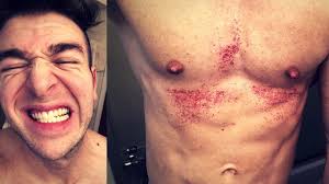From facial hair removal creams to options specially formulated for sensitive skin, these are the best hair removal creams, according to thousands of just remember, while these creams are generally regarded as safe, like all beauty products, some people may have allergic reactions from them. Chemical Burned With Nair Watch This Before Using Nair For Hair Removal Youtube
