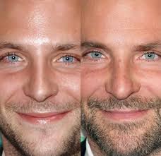 Milium cysts can cluster together to form milia spots that appear as white spots under eyes. Under Eye Bumps Not Milia Beauty Insider Community