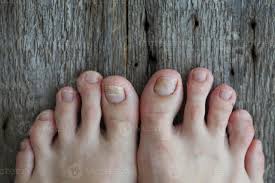 Image result for Onycholysis feet