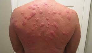 Soigner piqure punaise de lit. La Piqure De Punaise De Lit Traitement Punaise Com