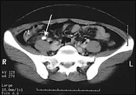 For most ct scans, you will be asked to stop eating about four hours before exam time, but fluids after a technician reads the images, the results are sent to your doctor within 24 hours. Imaging For Suspected Appendicitis American Family Physician