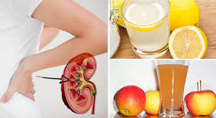 L'importanza della dieta per i calcoli renali è abbastanza relativa; 3 Modi Per Contrastare E Ridurre La Formazione Dei Calcoli Renali Renella