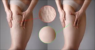 Rob oliver, plastic surgery 101 trying to understand what has so dramatically changed in our environment. How To Get Rid Of Cellulite Cellulite Treatment Methods Medical Wave