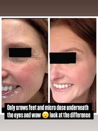 What a little Botox (neurotoxin) could do for the wrinkles around the eyes.  We did the crows feet (side of the eyes), micro dosing under the eyes. It  also opened up her eyes beautifully and got rid of ...
