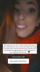 Pregnant women are advised to take extra care of their teeth during pregnancy, and are eligible for free dental care up to a year after their due date. Stacey Solomon Explains Reason She Got Veneers As Pregnancy Ruined Her Smile Aktuelle Boulevard Nachrichten Und Fotogalerien Zu Stars Sternchen