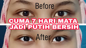 Batu mata kucing merupakan sarana untuk mengatasi berbagai masalah dalam kehidupan termasuk keberuntungan, daya ingat, kewibawaan, kejayaan, menetralisir energi negatif, pagar gaib. Obat Memutihkan Mata Yang Kuning Id Lif Co Id