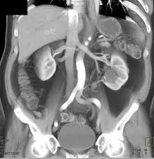 Image result for CT Intravenous Contrast