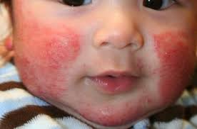 При обычных аллергиях препарат вводить можно. Allergicheskaya Syp U Detej Prichiny Vozniknoveniya Vidy I Metody Lecheniya
