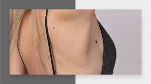 Topical creams, oils and mixtures used on the surface of the skin may help reduce the appearance of hair and remove surface hair but they are not going to prevent its regrowth. Can You Have Laser Hair Removal On Moles Urbana