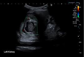 Image result for Perinephric Abscess