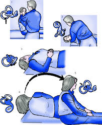 Image result for Canalith Repositioning Procedure