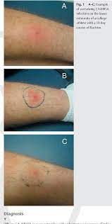 Jan 27, 2020 · a person may develop sepsis or pneumonia, for example, which can be fatal. Figure 1 From Methicillin Resistant Staphylococcus Aureus Mrsa In The Athlete Semantic Scholar