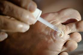 There are indeed countless options when it comes to plantar wart removing. Plantar Warts Symptoms Causes And Treatment