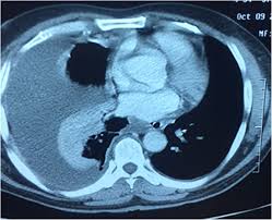 Loculated effusions occur most commonly in association with conditions that cause intense pleural inflammation, such as empyema, hemothorax, or tuberculosis. Role Of Medical Thoracoscopy In The Management Of Multiloculated Empyema Bmc Pulmonary Medicine Full Text