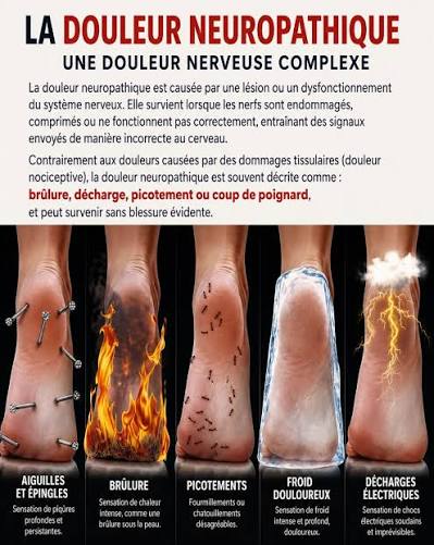Le syndrome des pieds brûlants se caractérise par une chaleur à la plante  des pieds et parfois par des picotements ou une douleur plus intense.