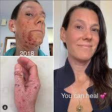 Även vaccin mot lunginflammation, stelkramp, difteri, bältros, vattkoppor och tbe. Anthony Williammette H A Desire 2 Inspirescandinavisk Livsstilblogg Om Spirituel Ren Halsa Vagen Till Omstallning Inre Saval Som Yttre
