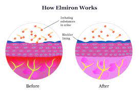 Common side effects of elmiron (pentosan polysulfate sodium) include: Elmiron Ic Drug Dosage Side Effect Information