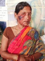 Caste Hindu man brutally beats up Dalit Woman, hurled Casteist slurs at her  Gorakhpur's Padri Bazar Chowki incharge Thakur Gaurav Singh entered the  house of Dalit woman Vimla Devi along with his