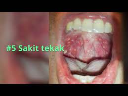 Selepas seseorang itu dijangkiti kuman virus ini tempoh pengeramannya adalah di antara 2 hingga 6 hari. Penyakit Hmfd Hand Foot Mouth Disease Kaki Tangan Dan Mulut