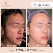 Làn da của bác sĩ Hải đã cải thiện rõ rệt sau khi điều trị với Proscar kết  hợp Refirm Sau khi áp dụng liệu trình Proscar kết hợp Refirm, bác sĩ