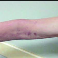 Aceasta afectiune cutanata este caracterizata de prezenta unei eruptii localizate, care apare de cele mai multe ori la nivelul fetei, pieptului de cele mai multe ori zona zoster se manifesta o singura data, episoadele recurente fiind extrem de rare. Pdf Acute Monoplegia Secondary To Herpes Zoster Infection A Case Report