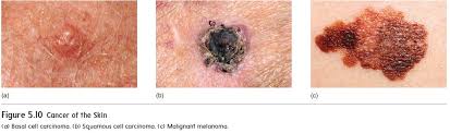 These are found on the outer layer of the skin and hence it is easy to cure them. Skin Cancer