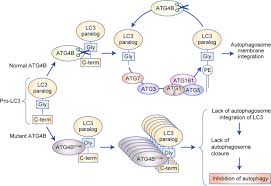 They may also occur when a tumor blocks or slows the regular digestive processes. Autophagy As A Therapeutic Target In Pancreatic Cancer British Journal Of Cancer