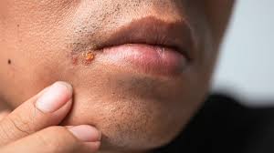 Image result for skin rash acute hiv infection
