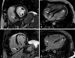 Myocarditis, also known as inflammatory cardiomyopathy, is inflammation of the heart muscle. Klinischer Nutzen Einer Kardio Mrt Untersuchung Bei Patienten Mit Akutem Myokardinfarkt Springerlink