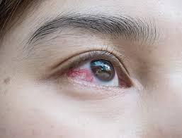 Broken Blood Vessel In Eye Phoenix Eye Doctors