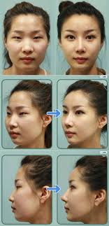 Beforeandafter Beforeandafterplasticsurgery Plasticsurgery Plastic Surgery Cosmetic And Plas Plastic Surgery Korea Korean Plastic Surgery Korean Surgery