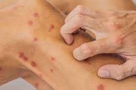 Image result for folliculitis symptoms