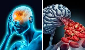 Cerebral vein and cerebral venous sinus thrombosis cerebral vein and cerebral venous sinus thromboses are blood clots that form in the veins that drain the blood from the brain called the sinuses and cerebral veins. Jthxybhefrq9em